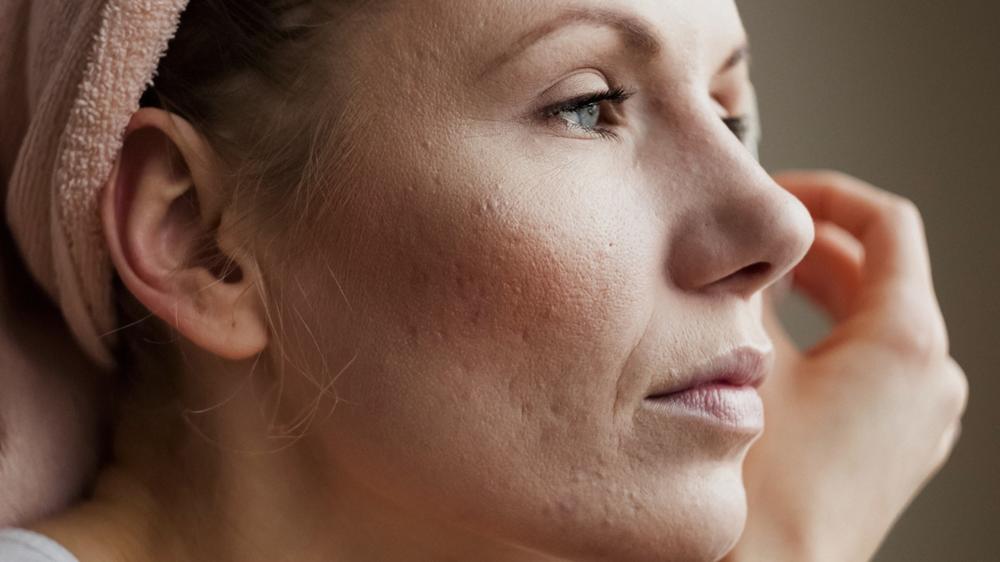 Nova pele no pós-parto: acne e outros problemas